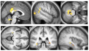 Meditation führt zur Zunahme Grauer Substanz